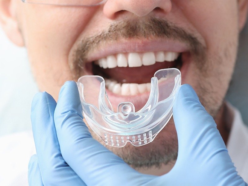 Unveiling the Benefits of Transparent Aligners for Subtle Teeth Straightening